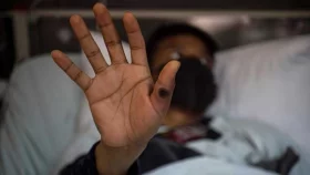 প্রথম এমপক্স টিকার অনুমোদন দিলো ডব্লিউএইচও